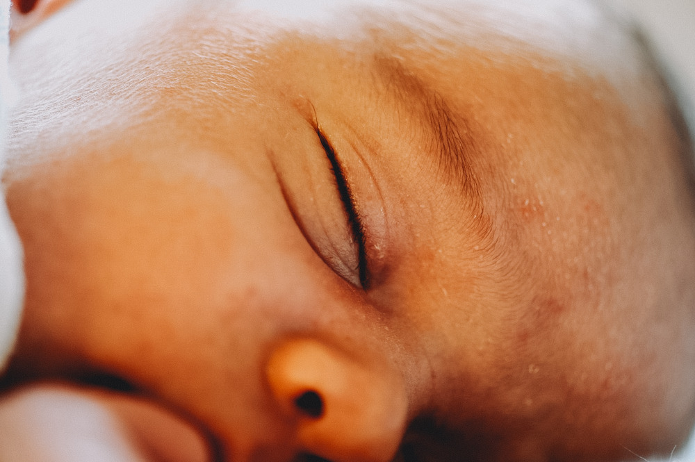 Eczema neonato
