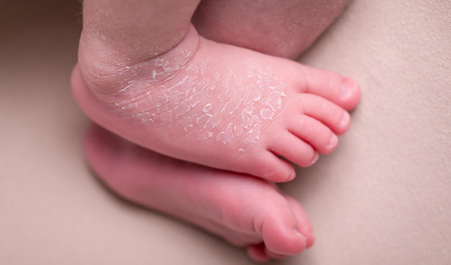 Come curare dermatite neonati